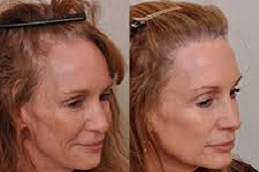 أفضل جراحة زراعة الشعر للنساء في الرياض