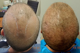 أفضل جراحة زراعة شعر الجسم في الرياض