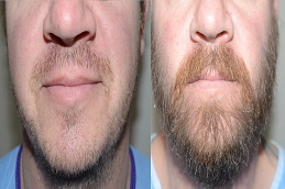 أفضل جراحة زراعة شعر اللحية في الرياض