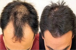 أفضل جراحة زراعة شعر بدون ندوب في الرياض