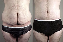 أفضل جراحة شد البطن المحيطي في الرياض