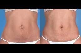 أفضل جراحة شد البطن المصغر في الرياض