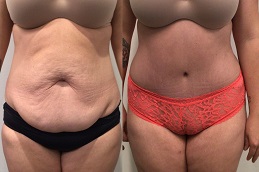 أفضل جراحة شد البطن في الرياض