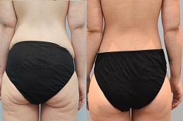 أفضل جراحة شد الجزء السفلي من الجسم في الرياض