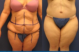 أفضل جراحة شد الجسم في الرياض