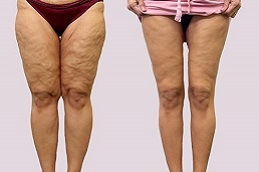 أفضل جراحة شد الفخذين في الرياض