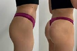 أفضل جراحة شد المؤخرة بدون جراحة في الرياض
