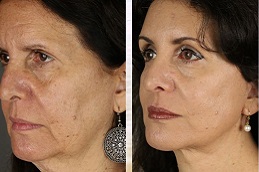 أفضل جراحة شد الوجه السحري في الرياض