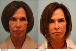 أفضل جراحة شد الوجه بالخلايا الجذعية في الرياض