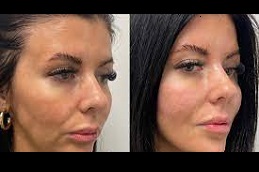 أفضل جراحة شد الوجه بالخيوط الناعمة بتقنية سيلويت في الرياض