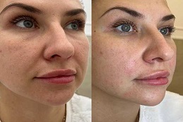 أفضل جراحة شد الوجه بالخيوط في الرياض