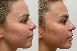 أفضل جراحة شد الوجه بخيوط السكر في الرياض