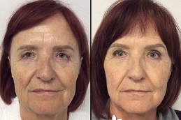 أفضل جراحة شد الوجه بدون جراحة في الرياض