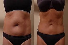 أفضل جراحة شفط الدهون بالليزر بتقنية GPS في الرياض