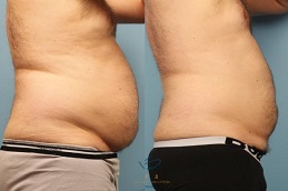 أفضل جراحة شفط دهون في جدة