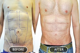 أفضل جراحة عضلات البطن في الرياض