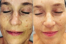 أفضل جراحة علاج إنزيم DMK في الرياض