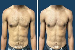 أفضل جراحة علاج التثدي في الرياض