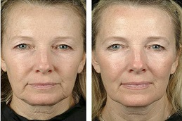 أفضل جراحة علاج الترددات الراديوية في الرياض