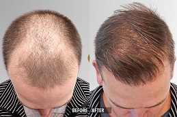 أفضل جراحة علاج الخلايا الصبغية في الرياض