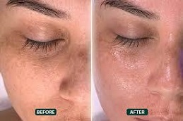 أفضل جراحة علاج الميزوثيرابي في الرياض