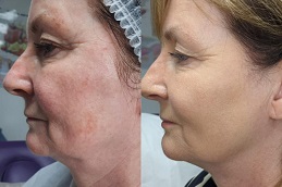 أفضل جراحة علاج الهايفو في الرياض