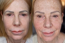 أفضل جراحة علاج الوخز بالإبر في الرياض