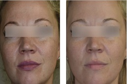 أفضل جراحة علاج عامل النمو المركز في الرياض