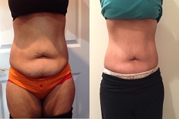 أفضل جراحة علاج فيلاشيب 3 في الرياض