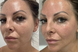 أفضل جراحة علاج ميزوغولد بالختم في الرياض