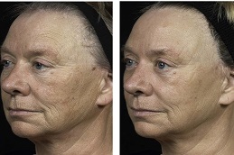 أفضل جراحة فراكسل بالليزر في الرياض