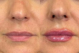 أفضل جراحة فوتونا لتكبير الشفاه رباعية الأبعاد في الرياض