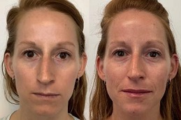 أفضل جراحة فولوما فيلر في الرياض