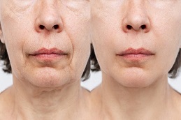 أفضل جراحة فيلر فوليفت في الرياض