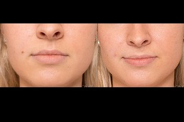 أفضل جراحة لإزالة الآفات الجلدية في الرياض