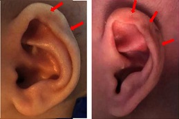 أفضل جراحة لإزالة الزوائد أمام الأذن في الرياض