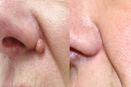 أفضل جراحة لإزالة الشامات في الرياض