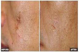 أفضل جراحة لإزالة الندبات بالليزر في الرياض