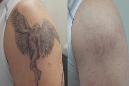 أفضل جراحة لإزالة الوشم بتقنية بيكو شور في الرياض