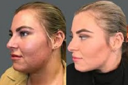 أفضل جراحة لإزالة دهون الخدود في الرياض