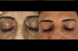 أفضل جراحة لإزالة زانثلازما الجفن في الرياض