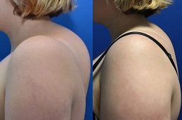 أفضل جراحة لإزالة سنام الجاموس في الرياض