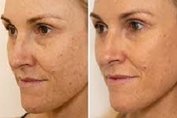 أفضل جراحة لعلاج التصبغات الجلدية في الرياض