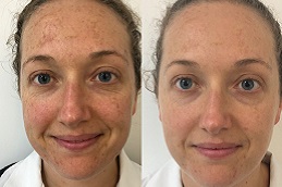 أفضل جراحة لعلاج التصبغات الجلدية في الرياض