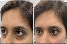 أفضل جراحة لعلاج الهالات السوداء في الرياض