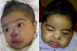 أفضل جراحة لعلاج الورم الوعائي الدموي في الرياض