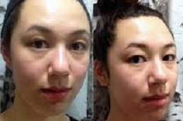 أفضل جراحة لعلاج جفاف الجلد في الرياض