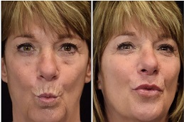 أفضل جراحة لعلاج شفاه المدخنين في الرياض