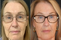 أفضل جراحة لعلاج مورفيوس ٨ في الرياض