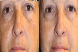 أفضل جراحة ليزر إيفو في الرياض